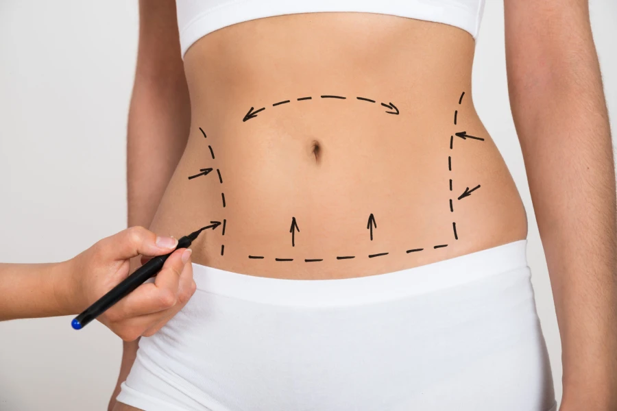 Yağ Aldırma Ameliyatı (Liposuction)