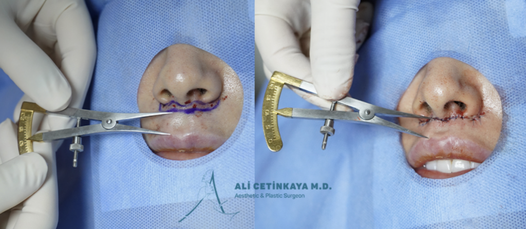 Dudak Kaldırma Ameliyatı