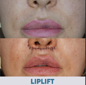 Üst Dudak Kaldırma İstanbul