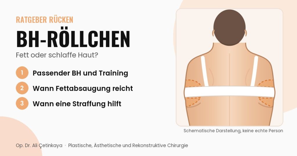 Schemazeichnung des Rückens mit hervorgehobenen Fettpolstern über und unter dem BH-Band