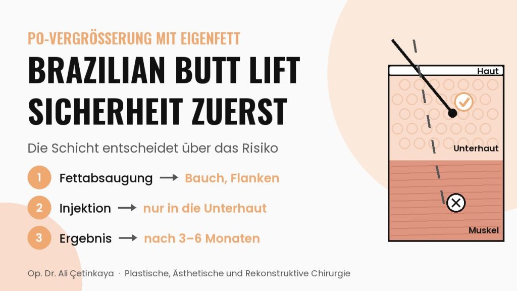 Schema der Gewebeschichten am Gesäß: Fett wird beim BBL in die Unterhaut übertragen, nicht in den Muskel