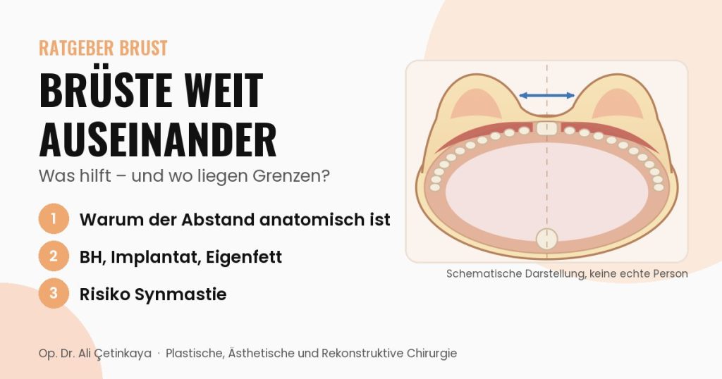 Schemazeichnung eines Brustkorb-Querschnitts von oben mit markiertem Abstand zwischen den Brüsten