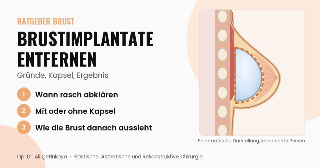 Schemazeichnung im seitlichen Schnitt durch die Brust mit Implantat und hervorgehobener Kapsel um das Implantat