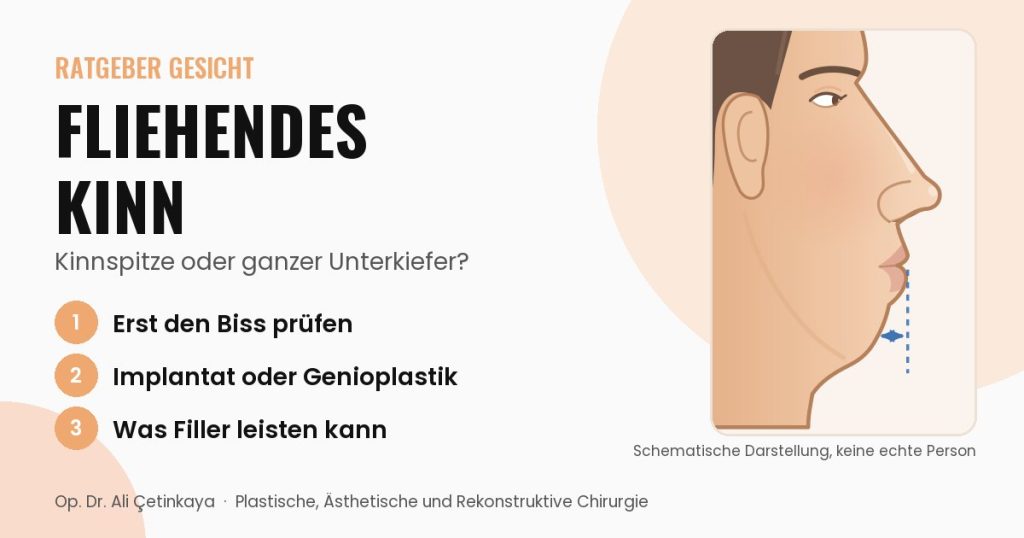 Seitliche Schemazeichnung eines Gesichtsprofils mit zurückliegendem Kinn und markiertem Abstand zur Lippenlinie