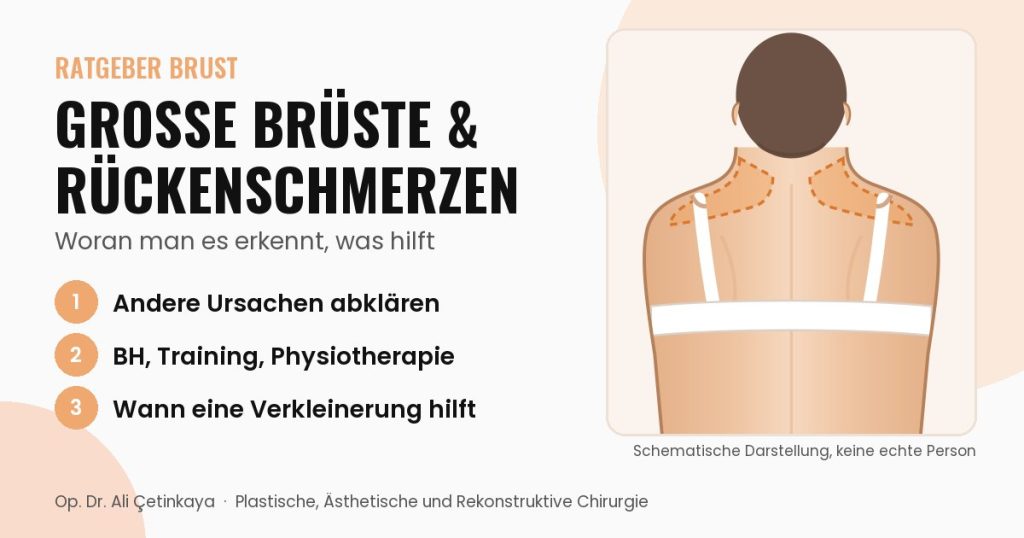 Schemazeichnung des Oberkörpers von hinten mit hervorgehobener Nacken- und Schulterregion und BH-Trägern