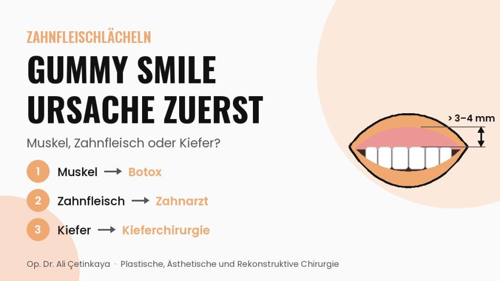 Schema eines Lächelns mit viel sichtbarem Zahnfleisch über den oberen Schneidezähnen (Gummy Smile)