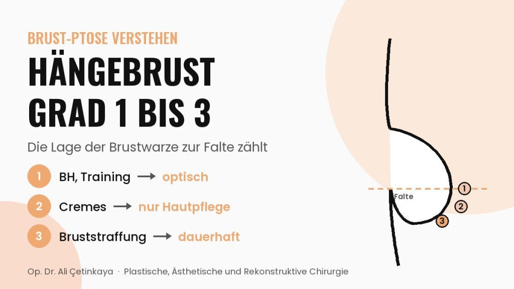 Seitliches Schema der Brust mit Unterbrustfalte und den Positionen der Brustwarze bei Hängebrust Grad 1, 2 und 3