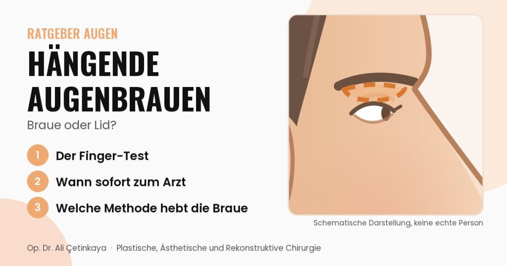 Seitliche Schemazeichnung der Augenpartie mit tief stehender Augenbraue und hervorgehobener Haut über dem Oberlid