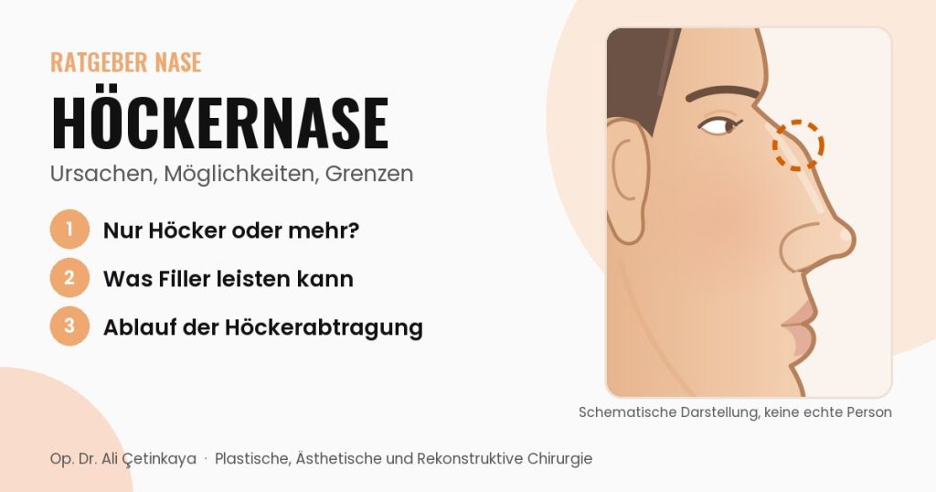 Seitliche Schemazeichnung eines Gesichtsprofils mit markiertem Höcker am Nasenrücken