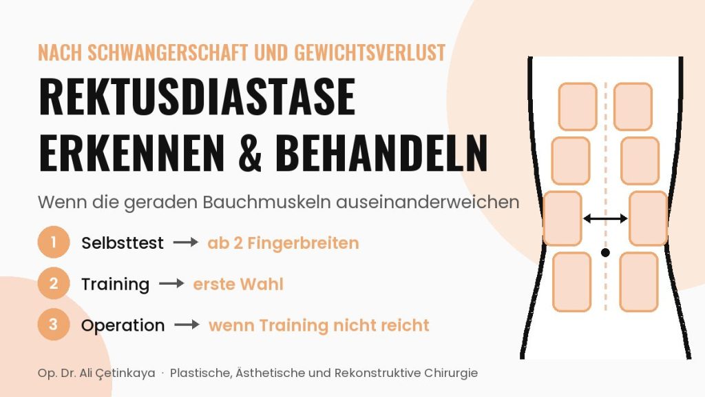 Schema der Bauchmuskeln mit Rektusdiastase: Lücke zwischen den geraden Bauchmuskeln, am Nabel am breitesten