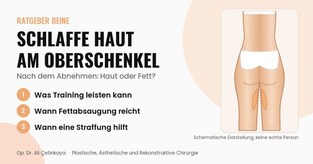 Schemazeichnung von hinten mit hervorgehobener hängender Haut an der Innenseite der Oberschenkel