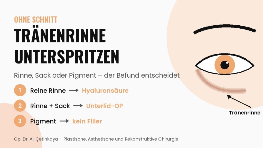 Schema eines Auges mit einer schattigen Tränenrinne zwischen Unterlid und Wange