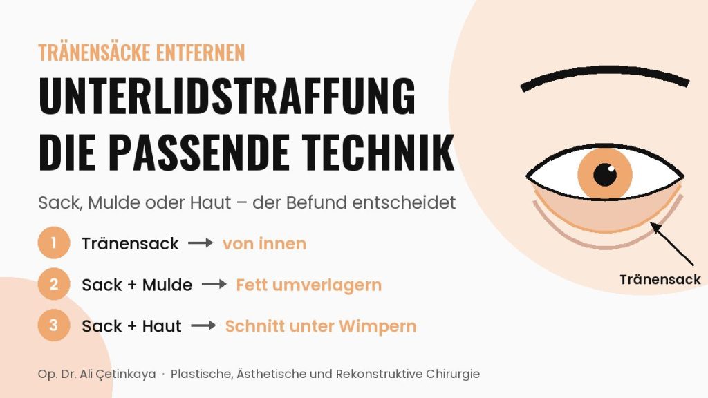 Schema eines Auges mit Tränensack unter dem Unterlid und Tränenrinne darunter