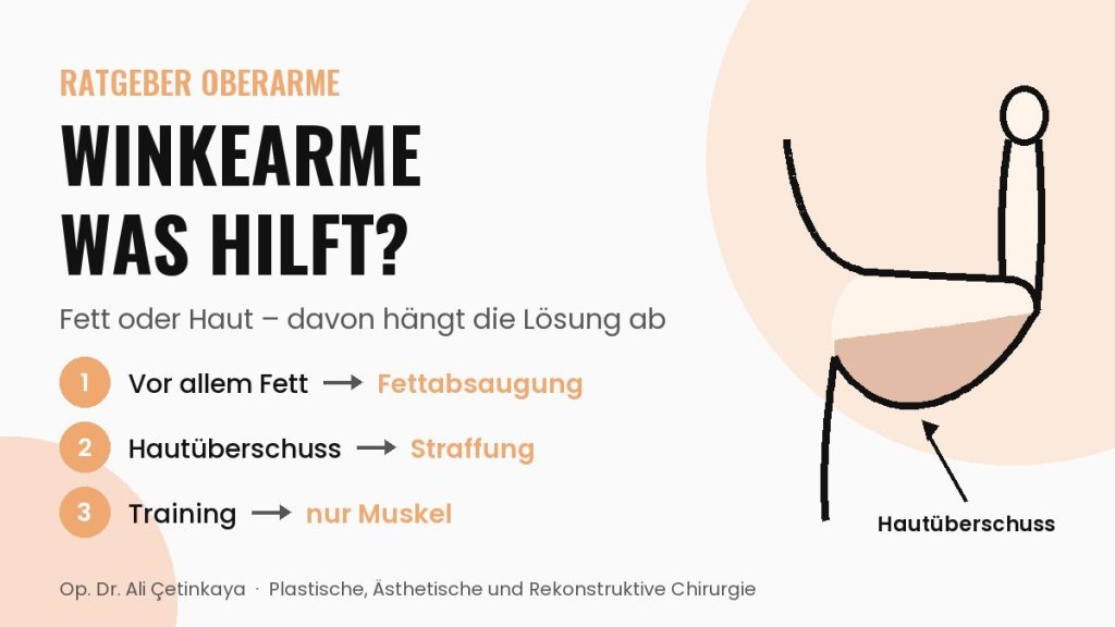 Schema eines angehobenen Arms, bei dem die hängende Haut an der Unterseite des Oberarms hervorgehoben ist