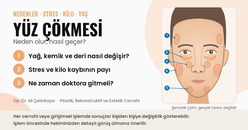 Yüz çökmesi şematik çizimi: önden yüzde hacim kaybının sık görüldüğü bölgeler (şakak, göz altı, yanak, çene önü). Gerçek bir hastaya ait değildir.